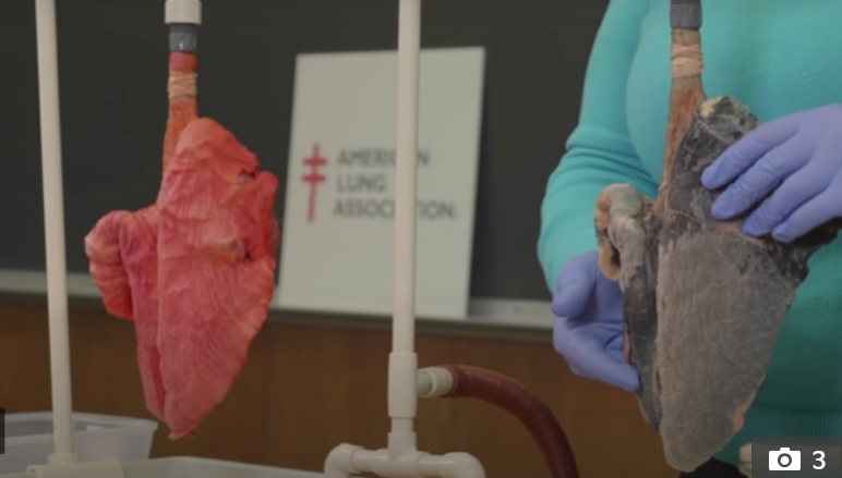 Experts reveal shocking difference between smoker's and non-smoker's lungs